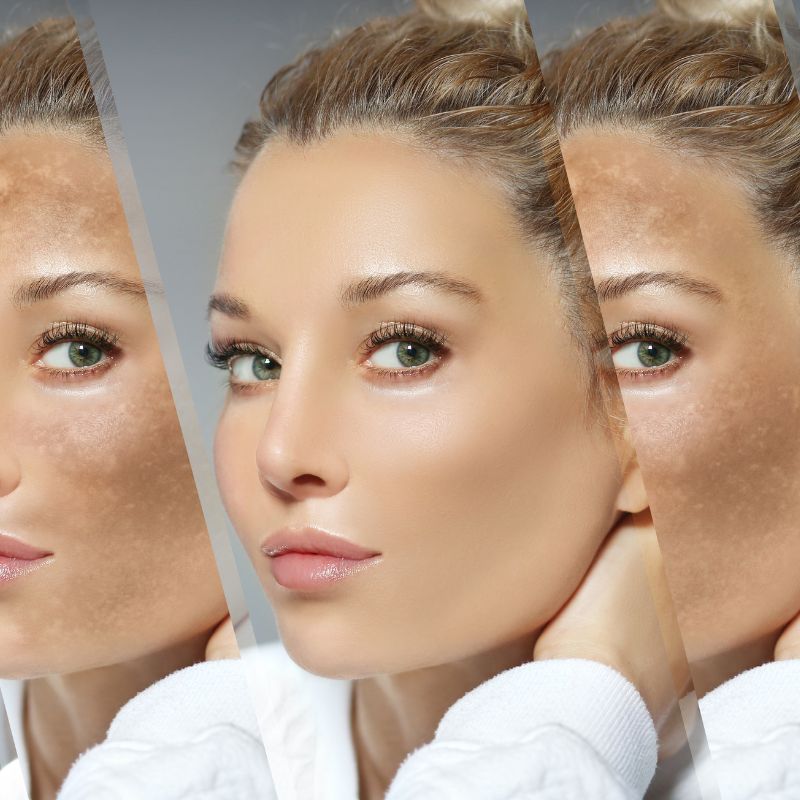 Skin Pigmentation Treatment